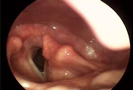VOCAL FOLD PARALYSIS: - via Daymix