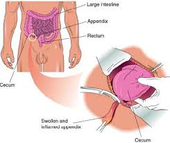 Laproscopic  appendectomy 