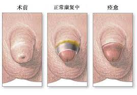 包皮包茎