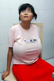 长沙一位12岁女孩患巨乳症 双乳长到 ...