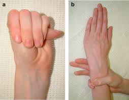  Arachnodactyly 