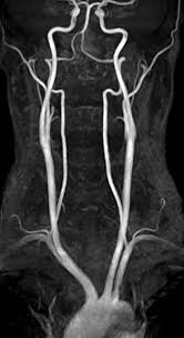 MR  ANGIOGRAPHY   MRA AND CONTRAST    