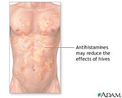  Hives  treatment