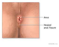 Anal Fissure