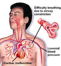 http://www.okanaganfirstaid.com/blog/wordpress/wp-content/uploads/2010/06/Anaphylaxis-3.jpg