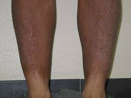 http://bearspace.baylor.edu/Charles_Kemp/www/amyloidosis2.JPG