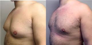 http://www.drsimoni.com/images/Gynecomastia.jpg