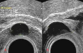 http://imageriedelaprostate.med.univ-tours.fr/carrefour_hypofertilite/Kyste_muller.jpg