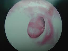 http://www.entsurgery.com.sg/Educational%2520Articles/TMperforation.jpg