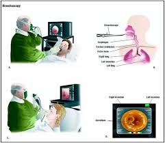 Bronchoscopy can be performed via
