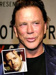 Mickey Rourke Plastic Surgery