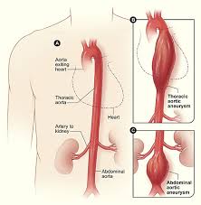 http://www.web-books.com/eLibrary/Medicine/Cardiovascular/Images/aneurysm_aortic.jpg