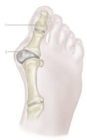 Illustration of a bunion