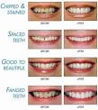 ACCU Dental | Veneers by Lumineers and Teeth Whitening | San Jose, CA