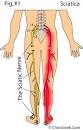 sciatica pronunciation