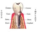 Dental Implant Companies a Information You Should Have About ...