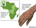 Ebola virus: MedlinePlus Medical Encyclopedia Image