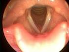 New UD tissue-engineer ing research focuses on vocal cords