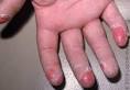 Scarlet Fever in an Infant or Baby: Condition, Treatment and ...
