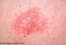 Allergic Contact Dermatitis Pictures