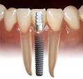 Be VERY Careful When Replacing Missing Teeth