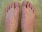 Rocky Mountain Spotted Fever Feet Rash Pictures