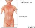 Signs of scarlet fever: MedlinePlus Medical Encyclopedia Image