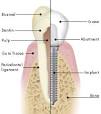 Dental Implants | Rocky Hill, Hartford, Newington, & Wethersfield ...