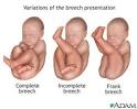 Breech Babies Are Another Variation of Normal | Birth Without Fear
