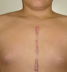 http://www.cirujanopediatra.cl/patologia/cicatriz/objetos/cicatriz.gif