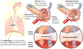 Interstitial lung disease