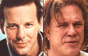 Mickey Rourke Plastic Surgery