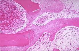 Healing fracture
