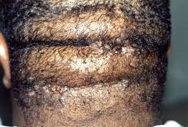 http://www.blackhairmedicalexpert.com/images/Acne_Keloidalis_Nuchae_Case-1-1-Year-Post-Op.jpg