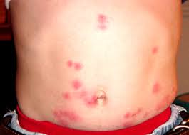Bed Bugs Symptoms - How To