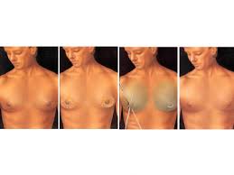 http://www.teamholiday.co.uk/img/companies/thumbs/400x300/Gynecomastia2.jpg