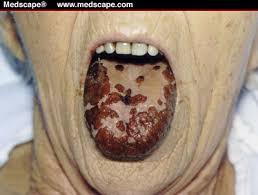 Tongue Condoms