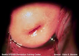 Normal Cervix