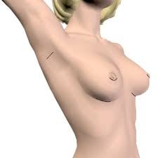 Breast augmentation involves