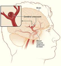 http://www.web-books.com/eLibrary/Medicine/Cardiovascular/Images/aneurysm_cerebral.jpg