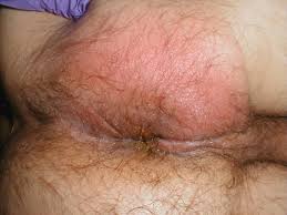 http://meded.ucsd.edu/clinicalimg/gu_perirectal_abscess.jpg