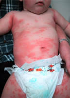http://www.guysandstthomas.nhs.uk/resources/Image/P/paediactricallergy/PaedAllergy_DrugAnaphylaxisInChild.jpg