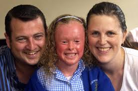 case of harlequin ichthyosis.