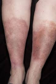 Stasis Dermatitis