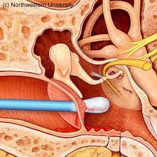 http://www.tchain.com/otoneurology/images/tmperf_c_d.jpg
