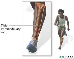 Bone fracture repair