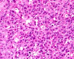 http://www.uoguelph.ca/~rfoster/repropath/surgicalpath/female/cat/F%2520fel%2520ovary%2520neoplasia%2520primitive%2520germ%2520cell%2520tumour%2520YB81905%252004wl.jpg