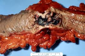 http://upload.wikimedia.org/wikipedia/commons/9/96/Adenocarcinoma,_colon,_gross_pathology_63_lores.jpg