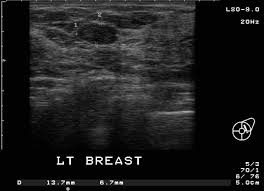 http://www.imagingpathways.health.wa.gov.au/includes/images/image/fibroadenoma.jpg