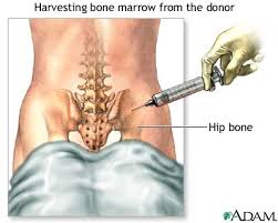 bone marrow is removed from the